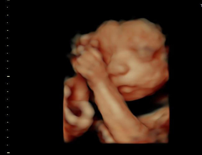 3D ultrasound image at 25 weeks